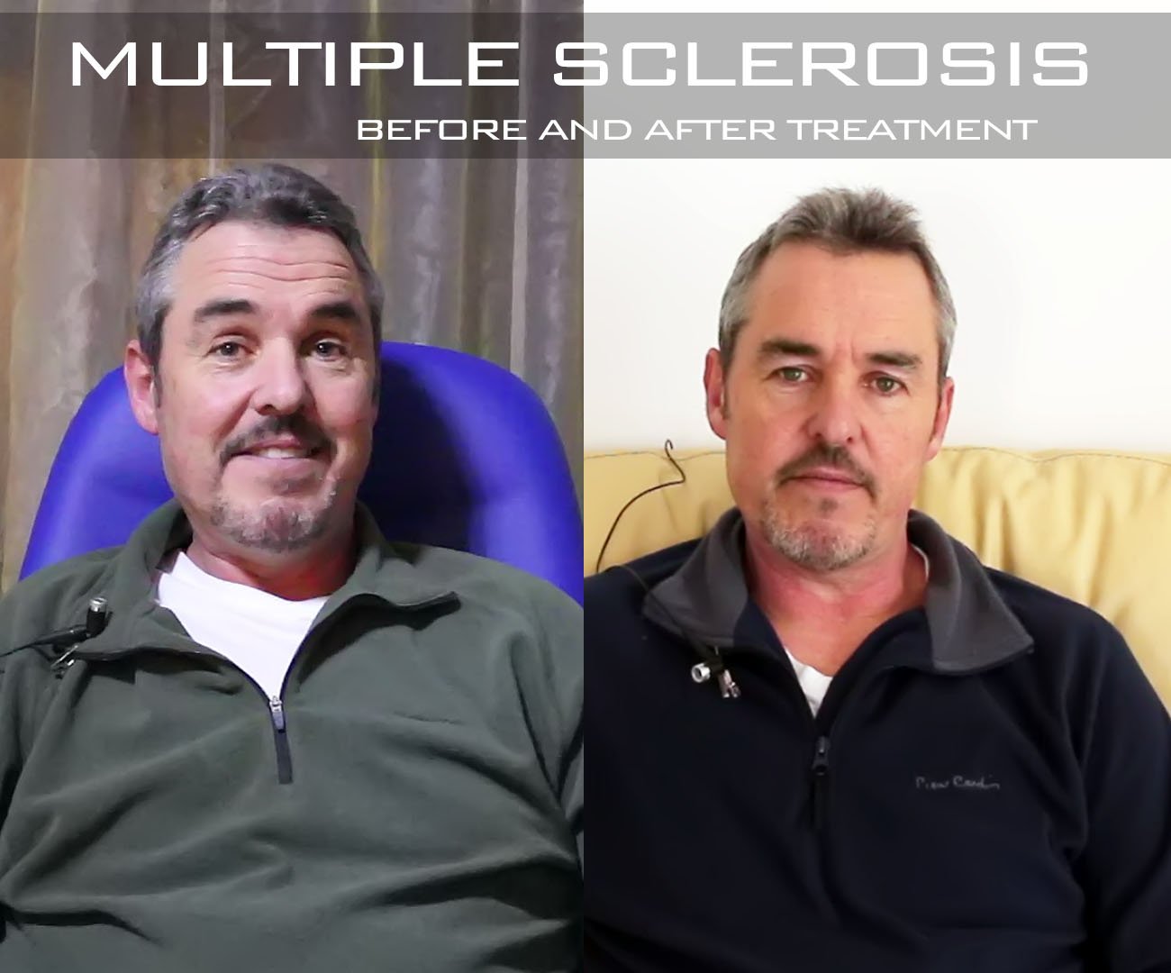 stem cell treatment for multiple sclerosis