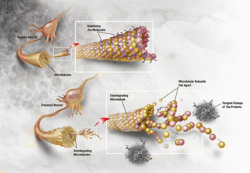 Alzheimers Disease Treatment With Stem Cells Therapy Swiss Medica