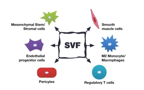 Stromal Vascular Fraction SVF New Approach In Stem Cell Therapy