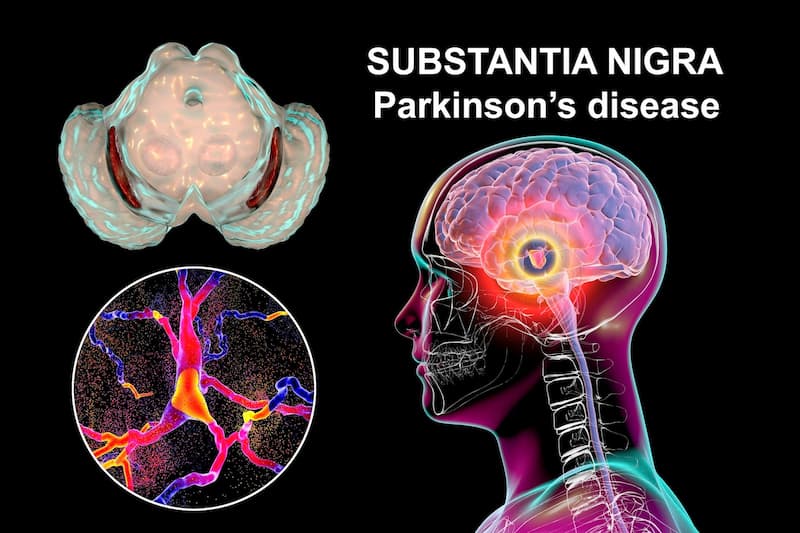 Parkinson's Treatment with Stem Cells