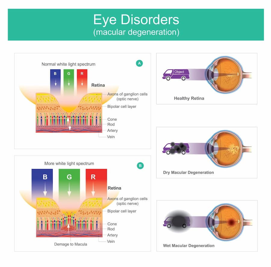 Macular Degeneration Treatment With Stem Cells