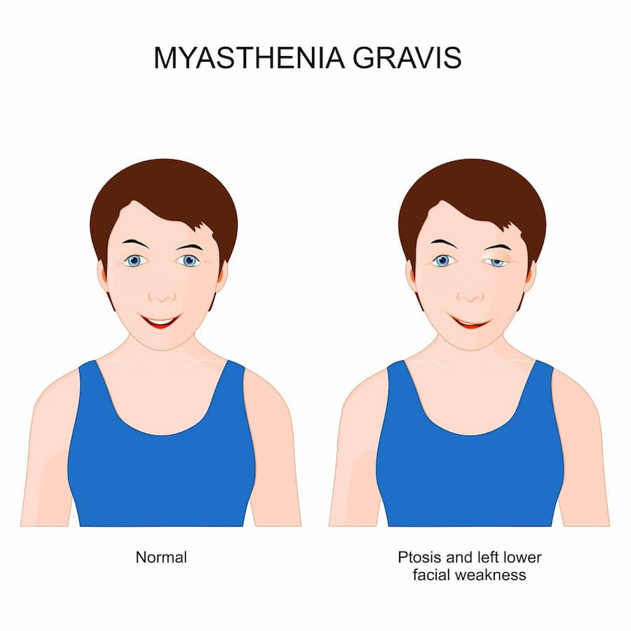 Myasthenia Gravis Treatment with Stem Cells