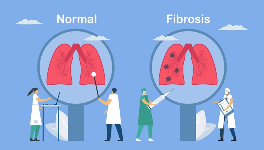 Stem Cell Therapy for Pulmonary Fibrosis