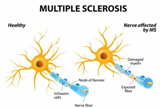 Multiple Sclerosis Treatment with Stem Cells