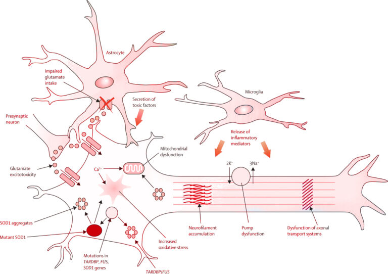 ALS Treatment with Stem Cells | Swiss Medica