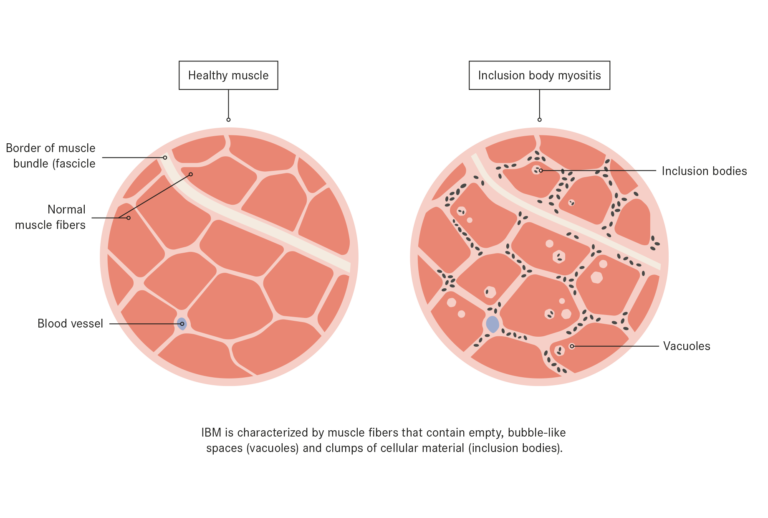 Inclusion Body Myositis Treatment with Stem Cells Swiss Medica