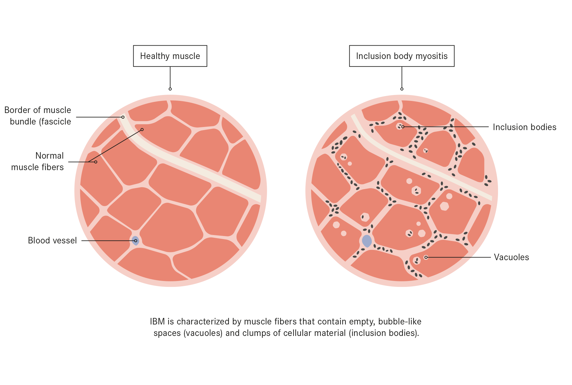 Inclusion Body Myositis Treatment With Stem Cells Swiss Medica