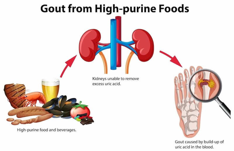 Stem Cell Therapy for Gout