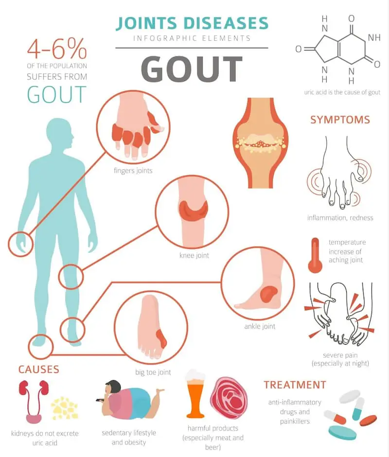 Stem Cell Therapy for Gout