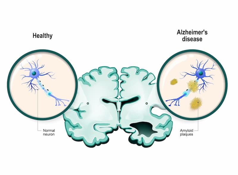 Stem Cell Therapy for Alzheimer's