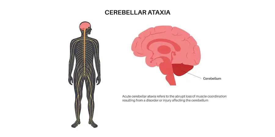 Understanding Ataxia Disease: Symptoms, Diagnosis, and Treatment ...