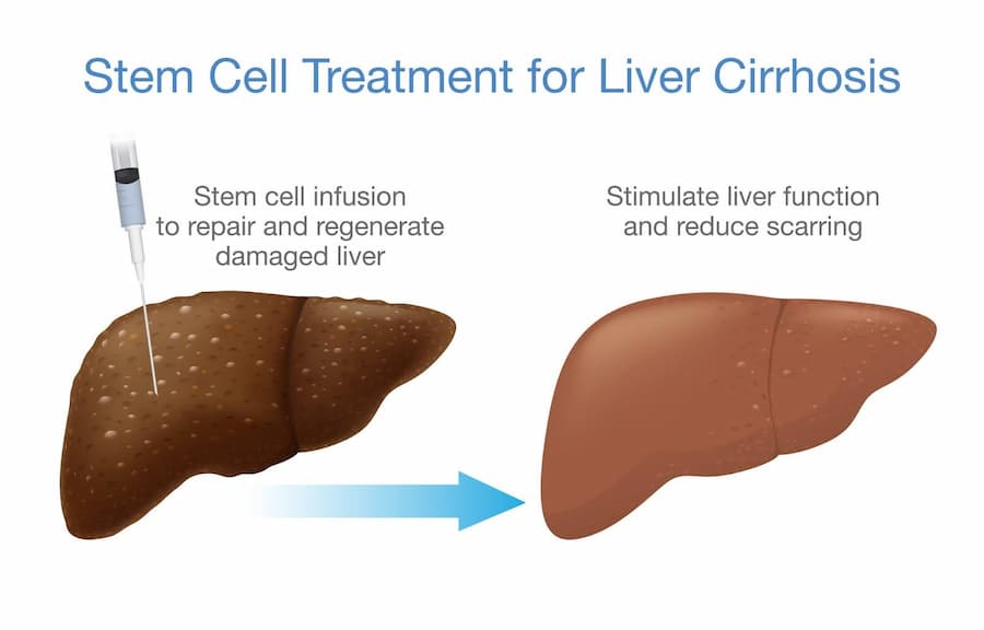 Liver Cirrhosis And Stem Cell Treatment