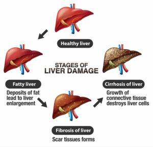 Liver Cirrhosis And Stem Cell Treatment | Swiss Medica