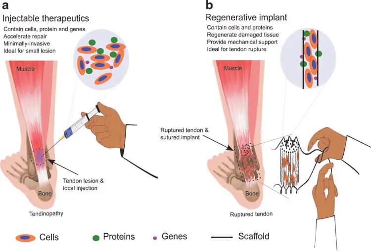 Stem Cell Therapies and Tendon Repair