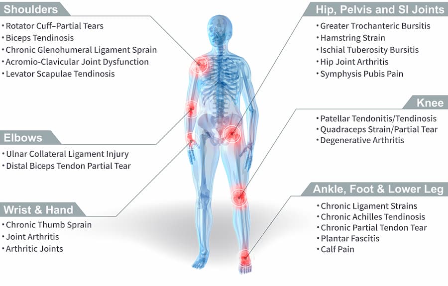 Stem Cell Therapies and Tendon Repair