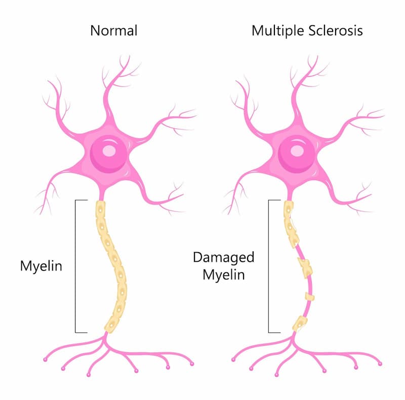 Early Symptoms Of Multiple Sclerosis In Women You Need To Know