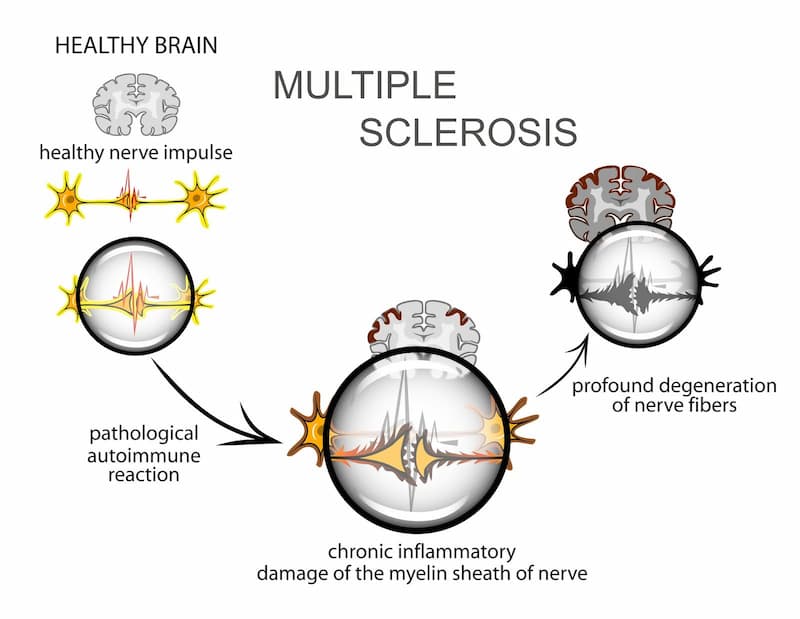 Types Of MS: 4 Forms Of Multiple Sclerosis