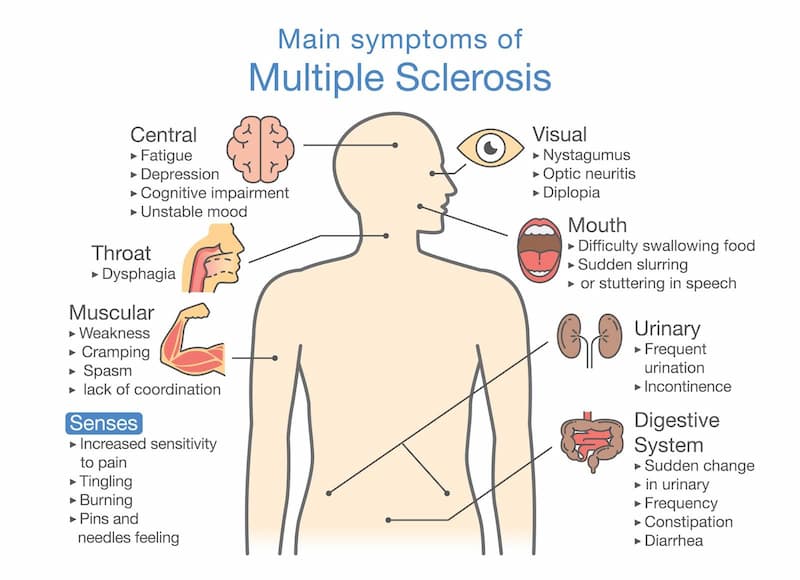 Early Symptoms Of Multiple Sclerosis In Women You Need To Know