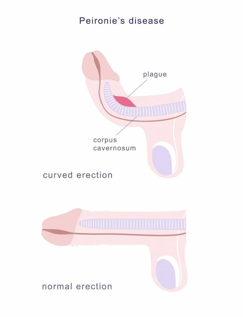 Stem Cells for Peyronie's Disease