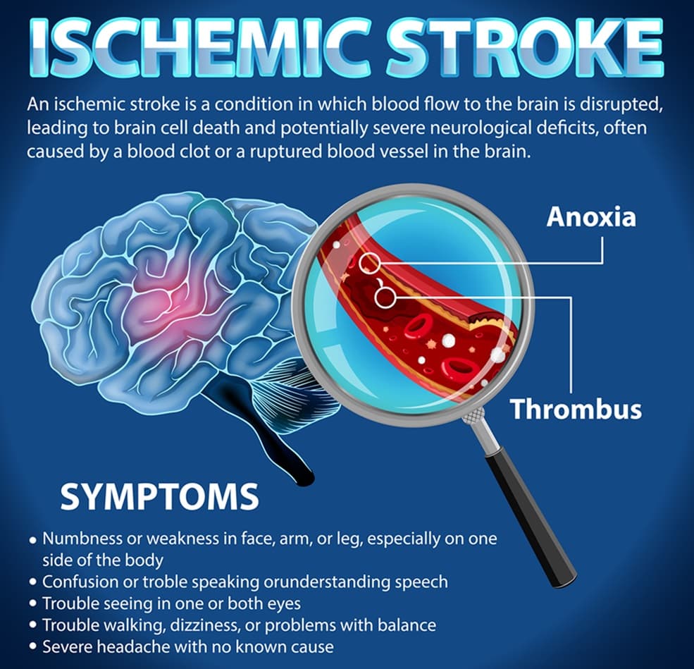 Stem Cell Therapy for Brain Injury