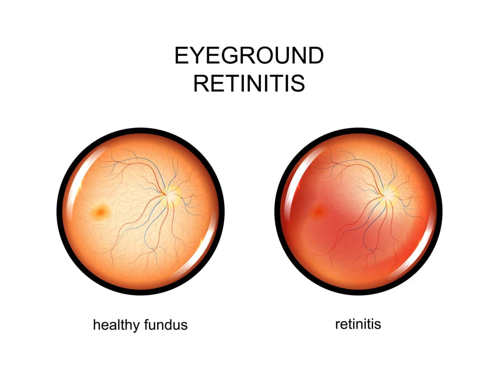 Stem Cell Therapy for Retinitis/Retinopathy