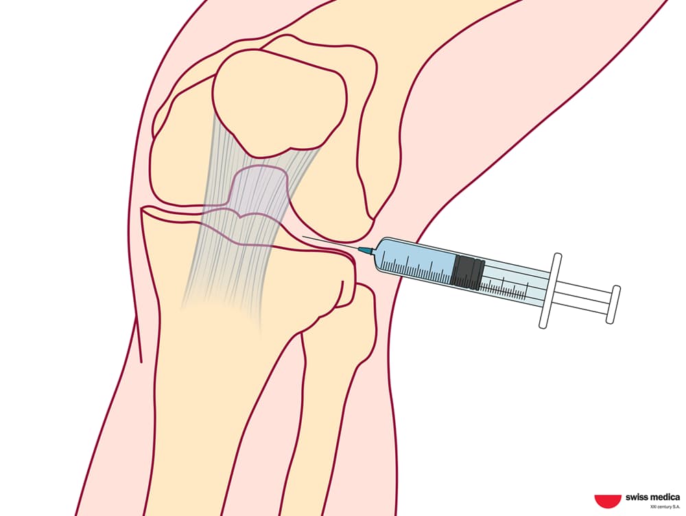 Stem Cell Delivery Methods