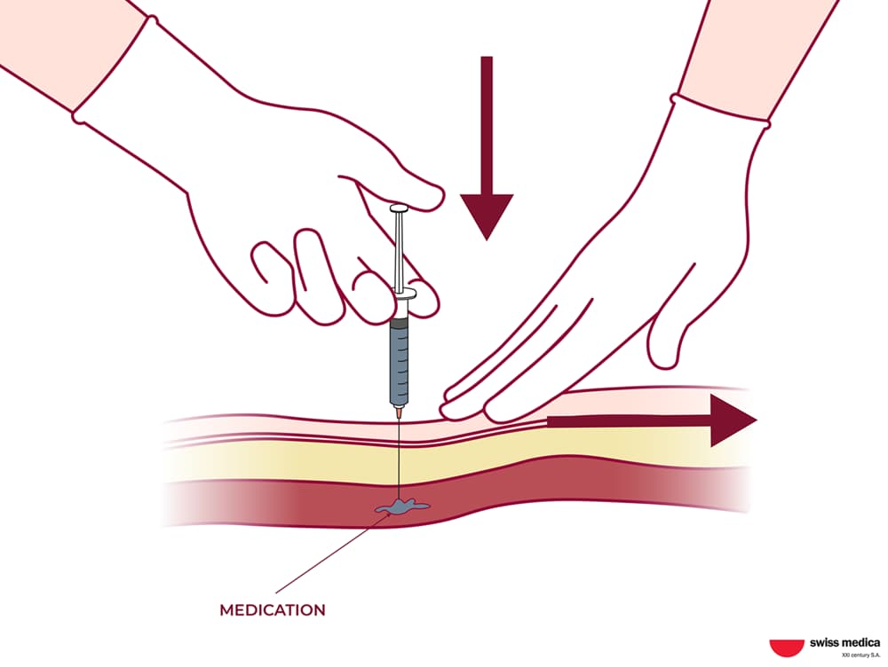 Stem Cell Delivery Methods