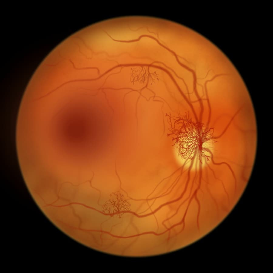 Stem Cell Therapy for Retinitis/Retinopathy