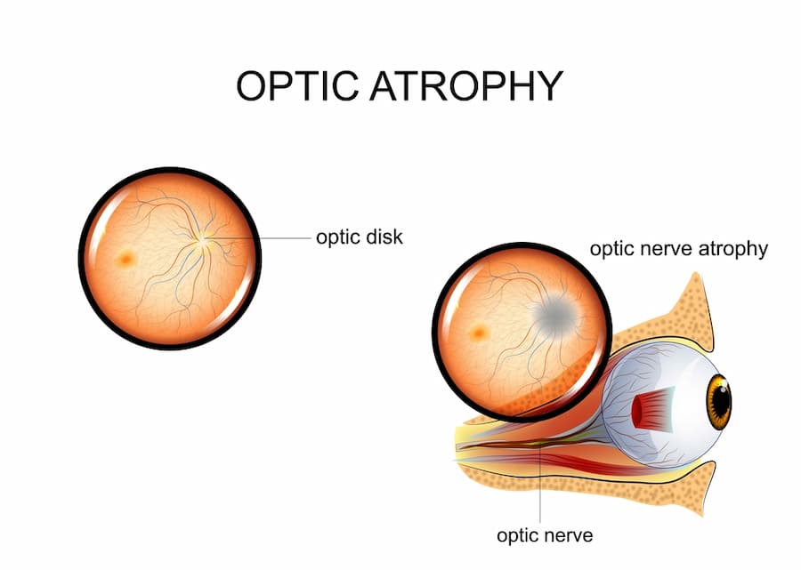 Stem Cell Treatment for Optic Nerve Atrophy