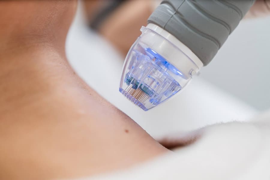 Radiofrequency Microneedling