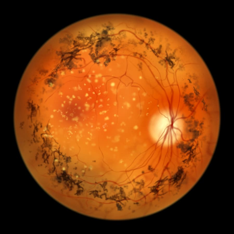 Stem Cell Therapy for Retinitis/Retinopathy