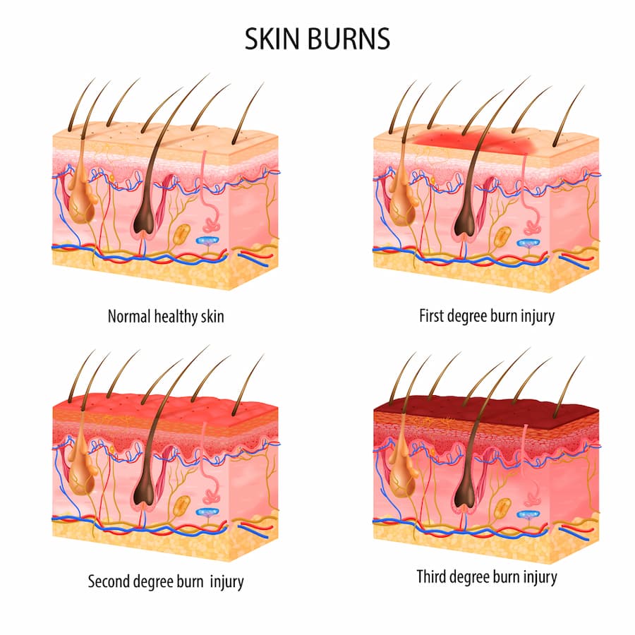 Stem Cell for Burns Treatment